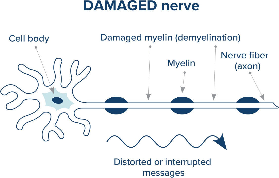 damaged nerve